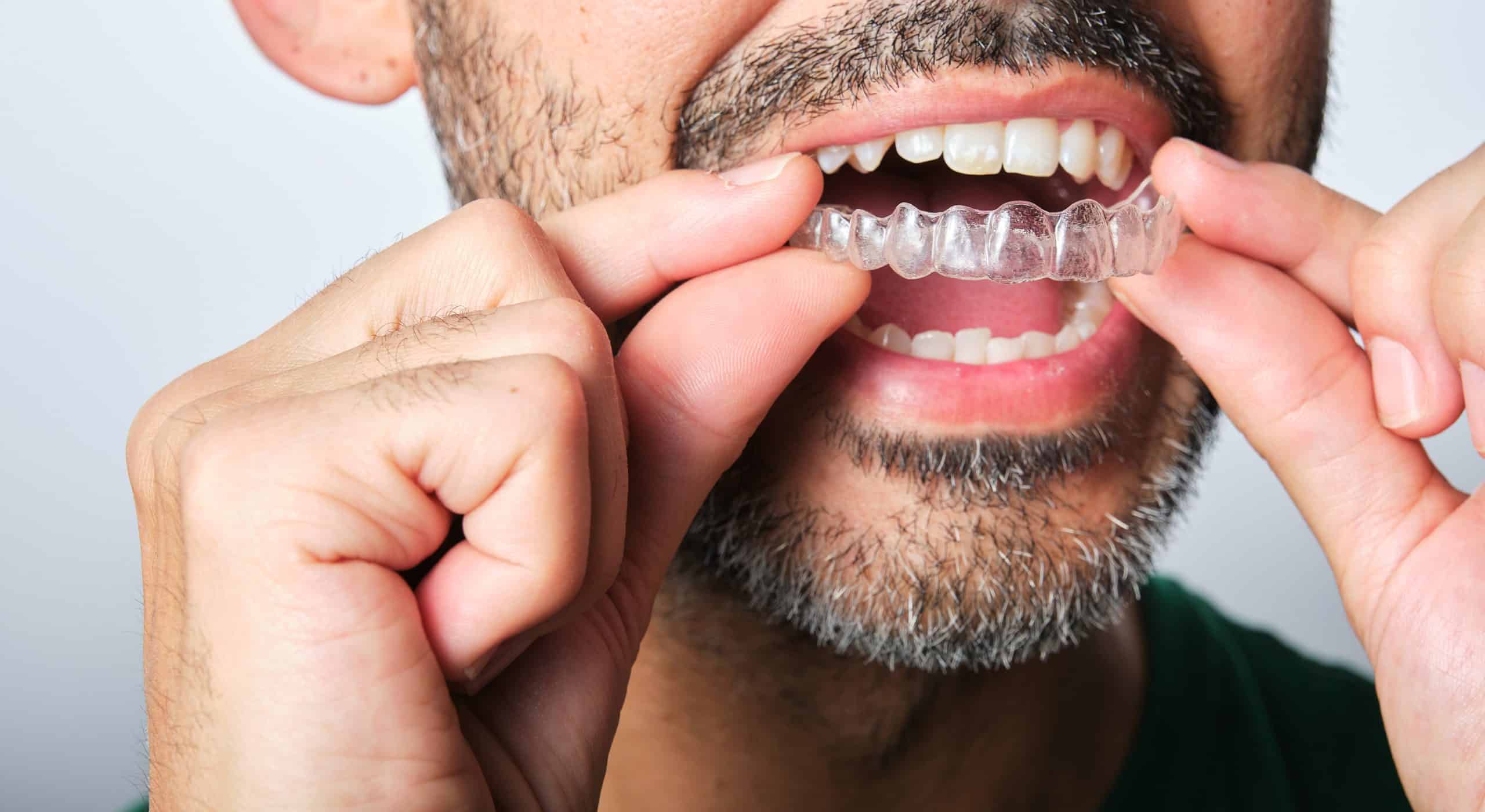close up of man with invisalign - Moonflower Dentistry