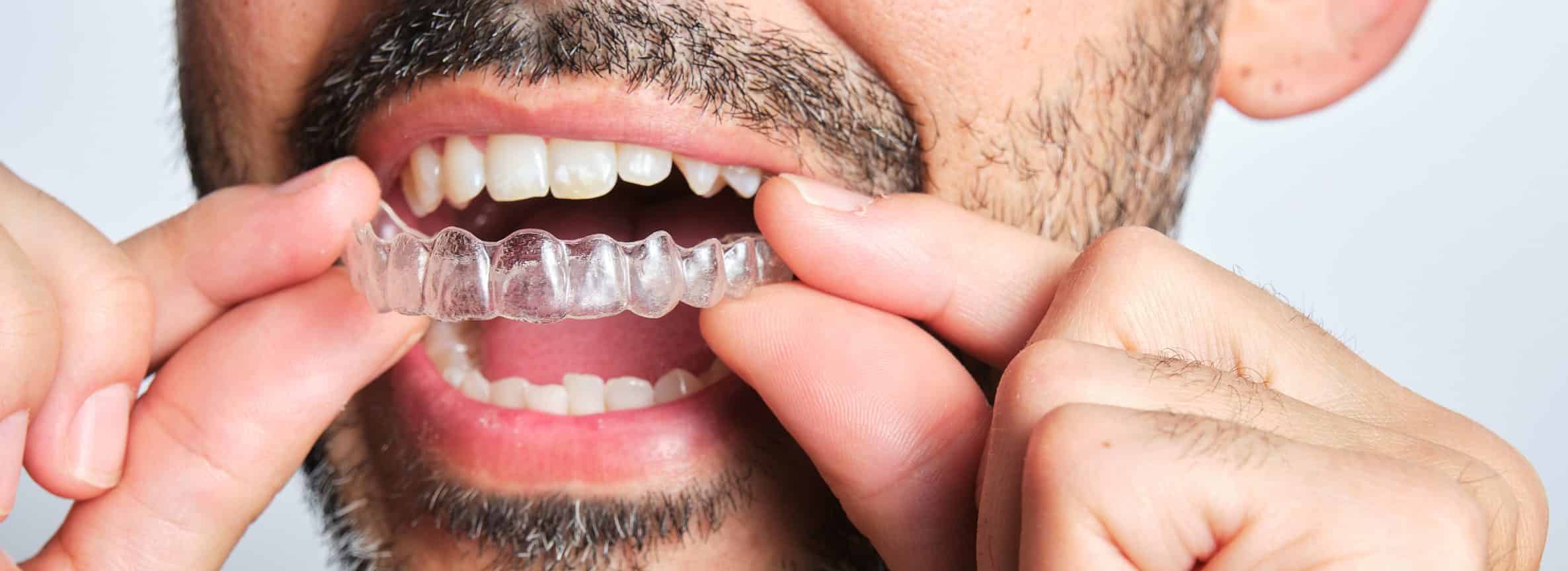 close up of man with invisalign - Moonflower Dentistry