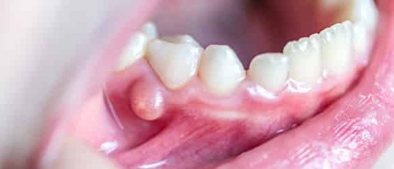 Close-up of a into kids mouth that has a Blister, pustule on the gums