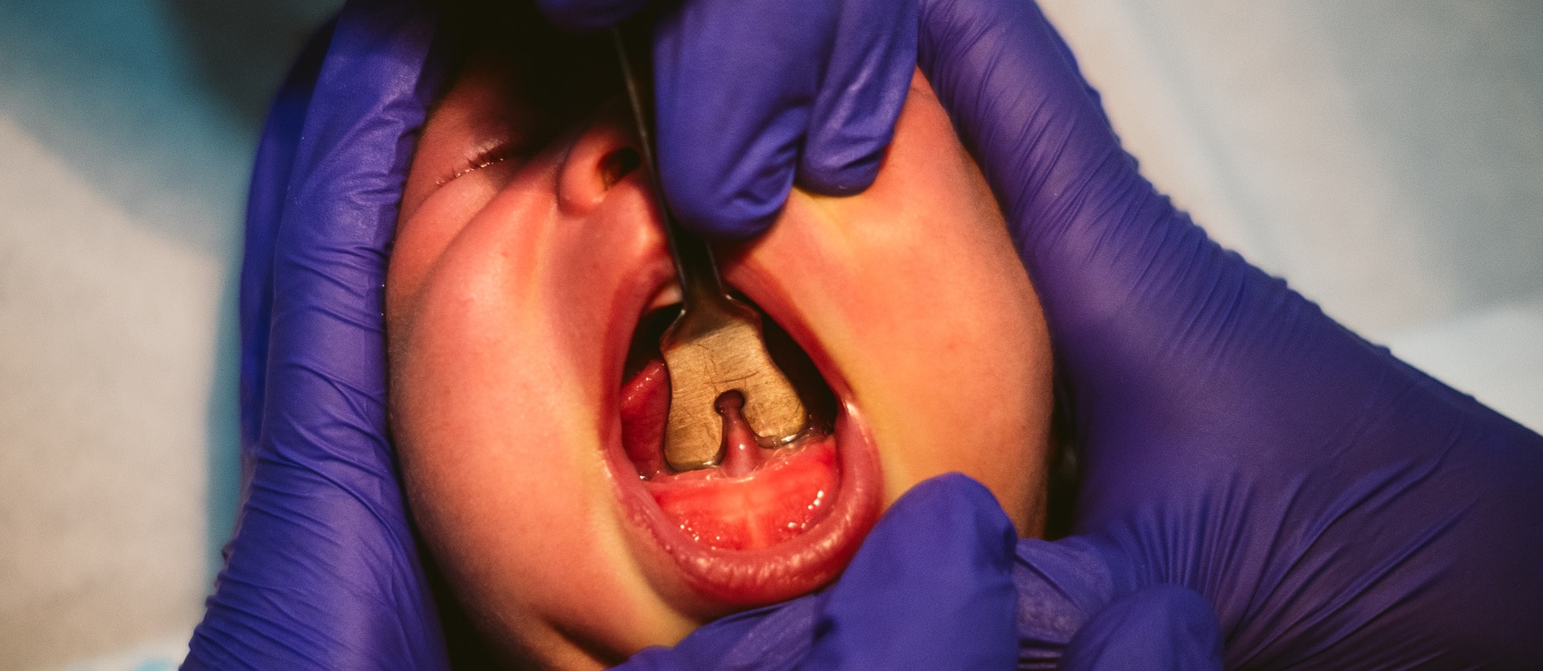 Baby during a buccal frenectomy surgery in Pacific Grove CA