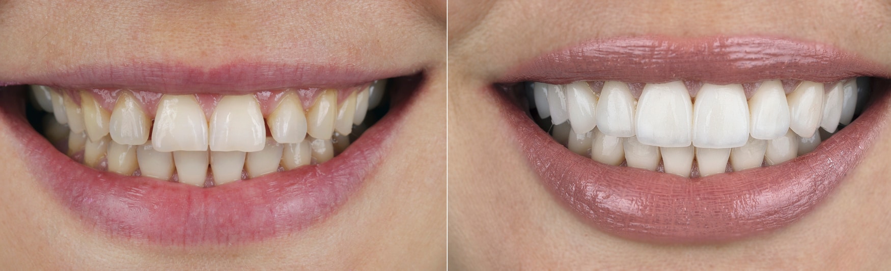 Example of a smile makeover at Moonflower Dentistry