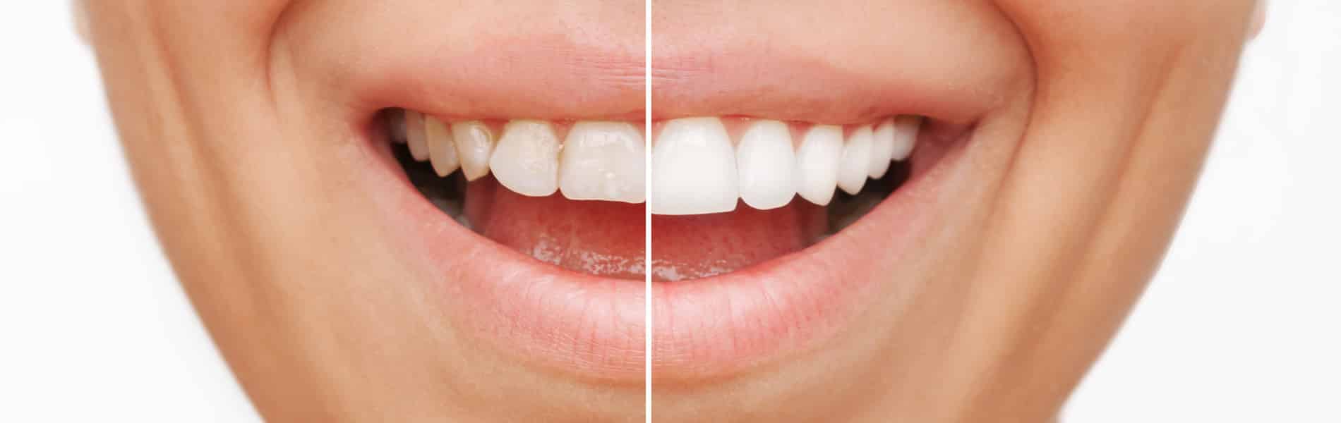 The before and after photo of veneers from Dr. Vicente Carrazana
