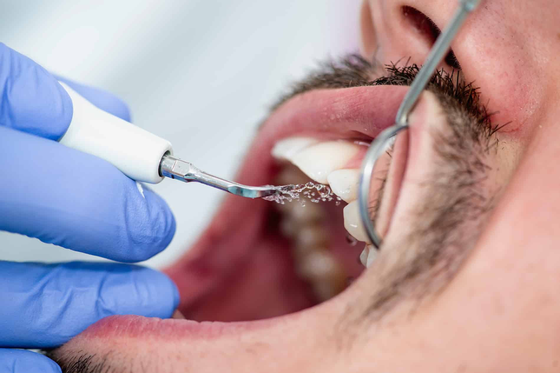 Professional teeth cleaning at Moonflower Dentistry