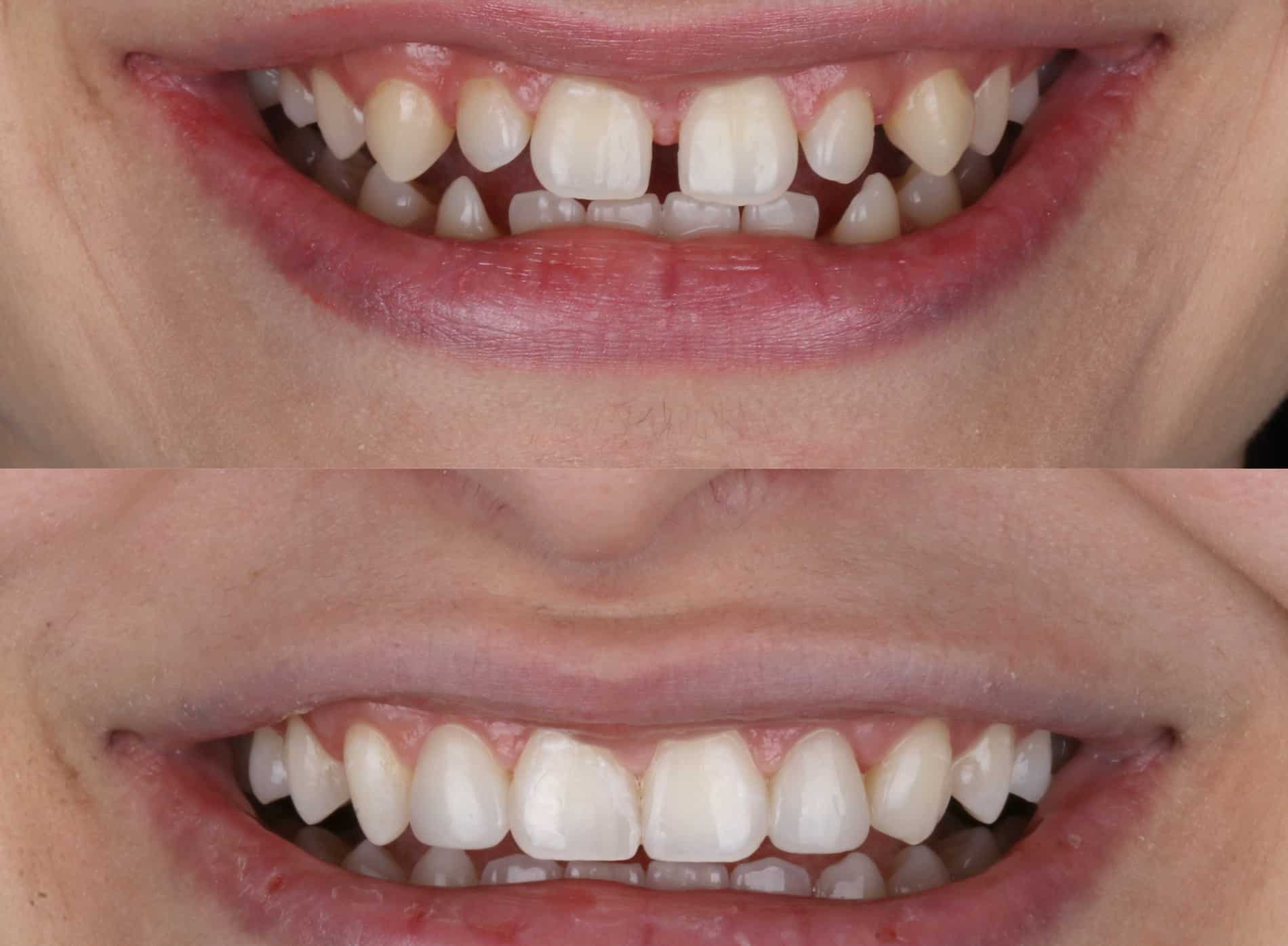 Tooth bonding before and after from MoonFlower Dentistry in Pacific Grove CA