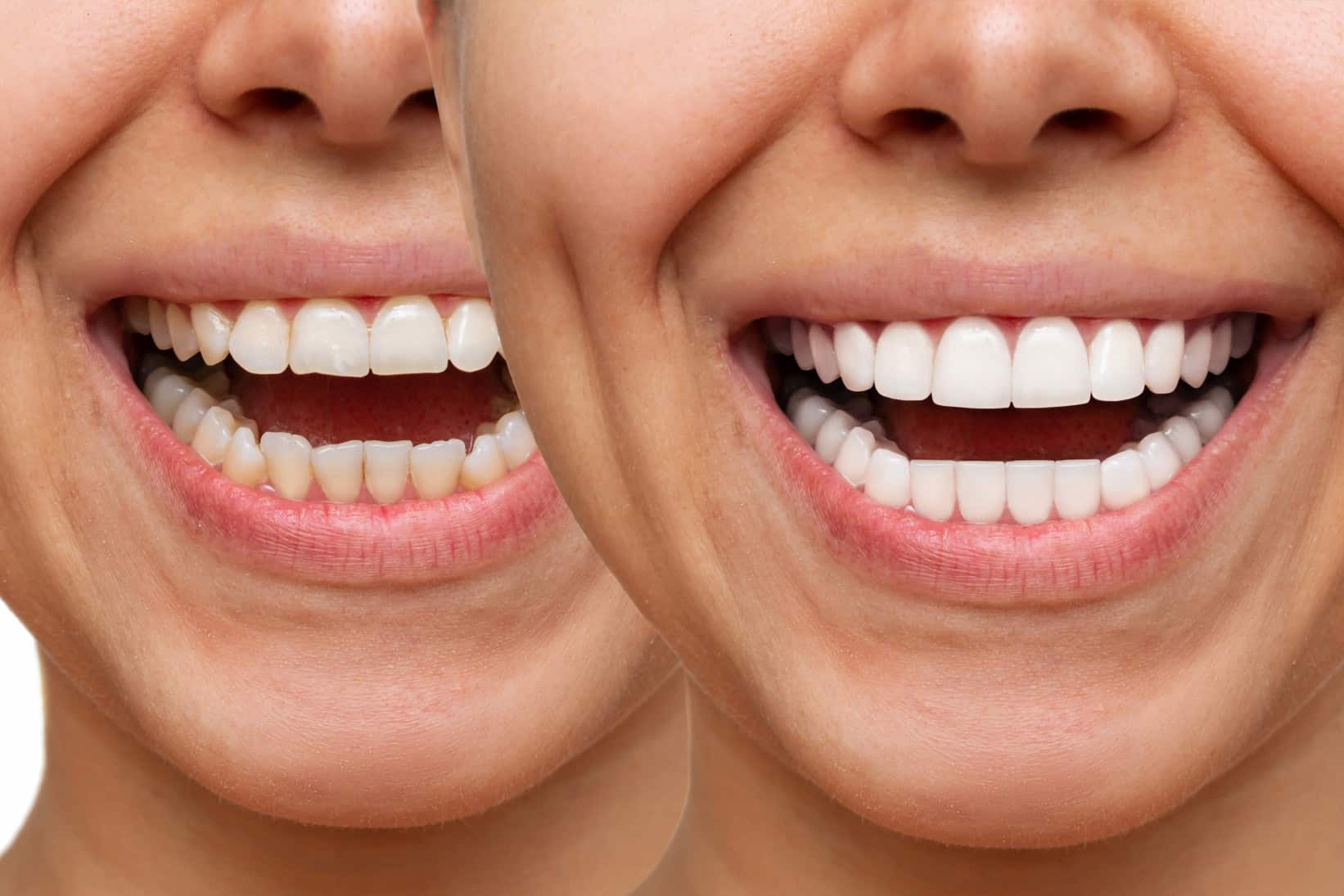 The before and after photo of veneers from Dr. Vicente Carrazana