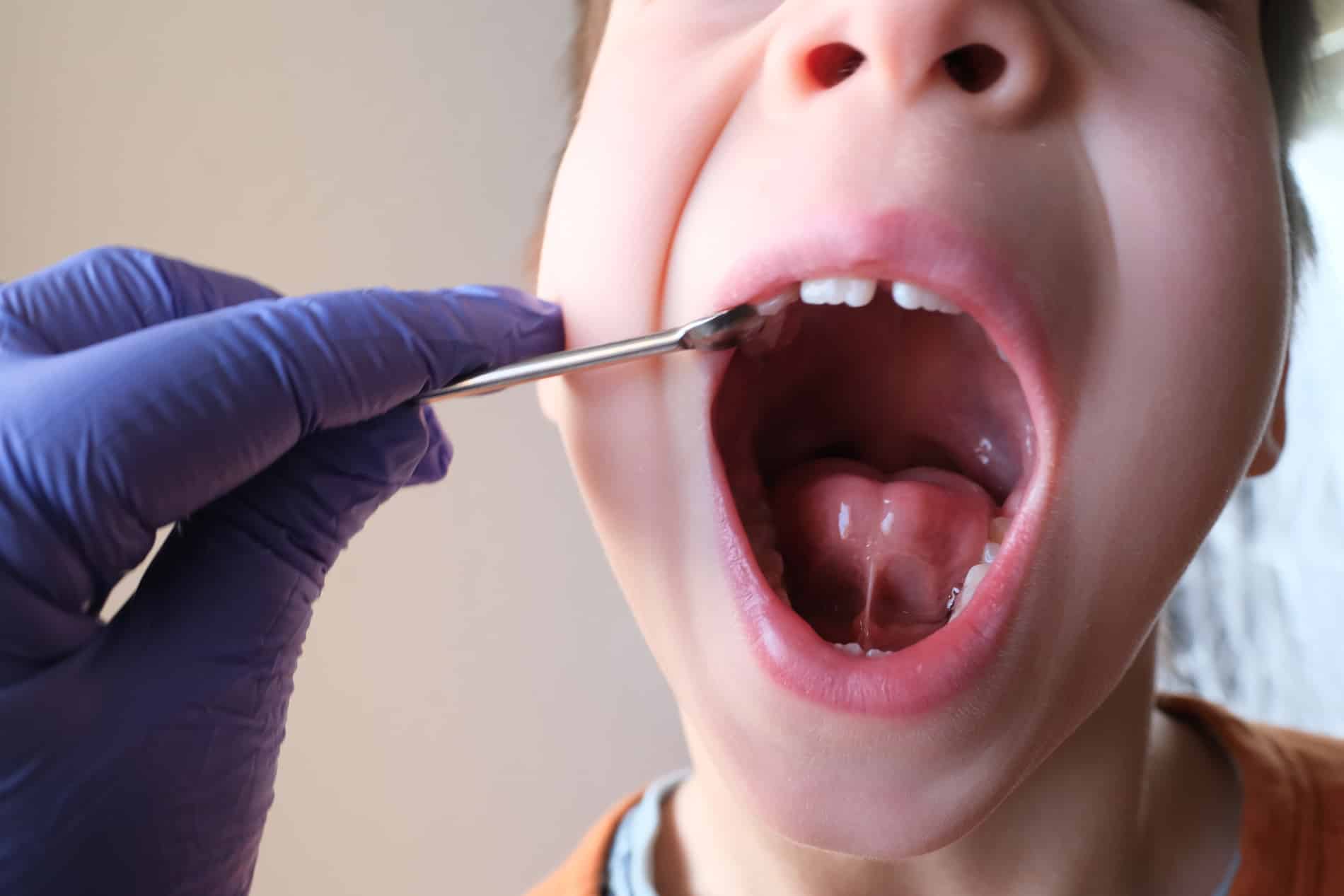 Child during a buccal frenectomy surgery in Pacific Grove CA