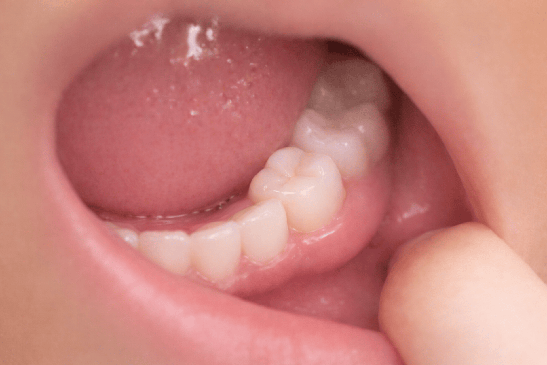 Child shows their zirconia dental crowns in Pacific Grove CA