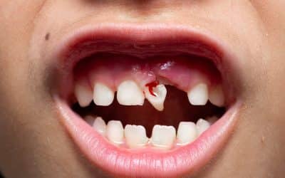 Dental Emergencies in Children: What Parents Need to Do in Pacific Grove, CA