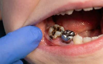 Pediatric Dental Crowns: Why Kids Sometimes Need Them in Pacific Grove, CA