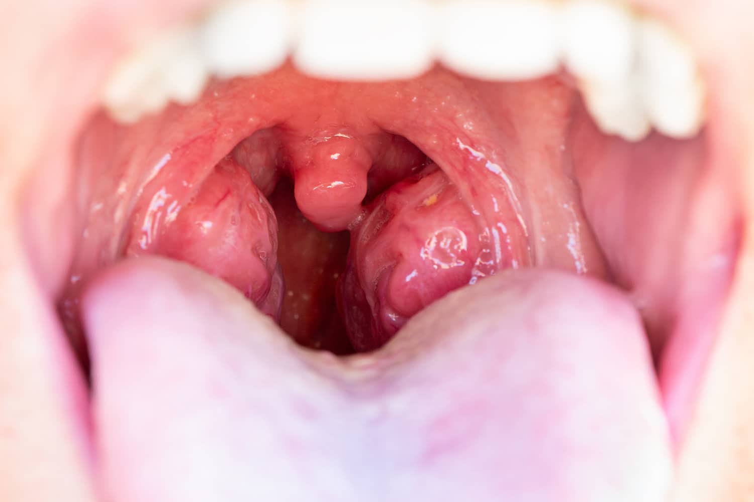 Child's throat at an airways assesment for kids with Dr. Kritika in Pacific Grove
